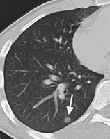 CT of the lung with a nodule finding