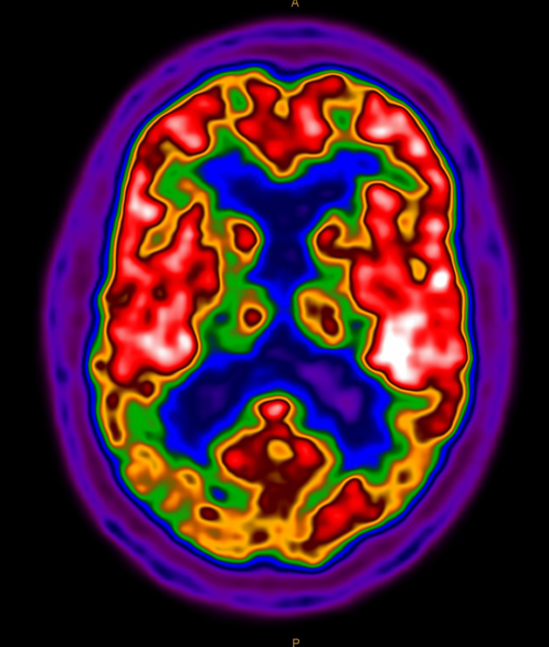 PET & PET/CT - Partners Imaging Centers | 3T MRI, CT, X-Ray, PET, Mammo ...